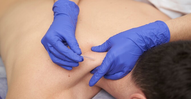 Dry Needling